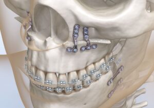 Illustration showing results of corrective jaw surgery