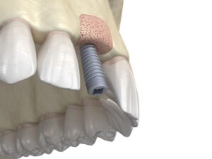 Illustration of dental implant in upper jaw at site of bone graft